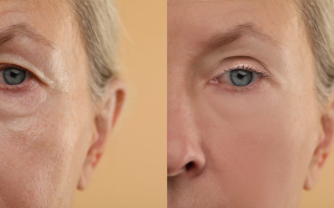 Expert Dermatologists Weigh In on Laser Eyelid Tightening: What You Need to Know