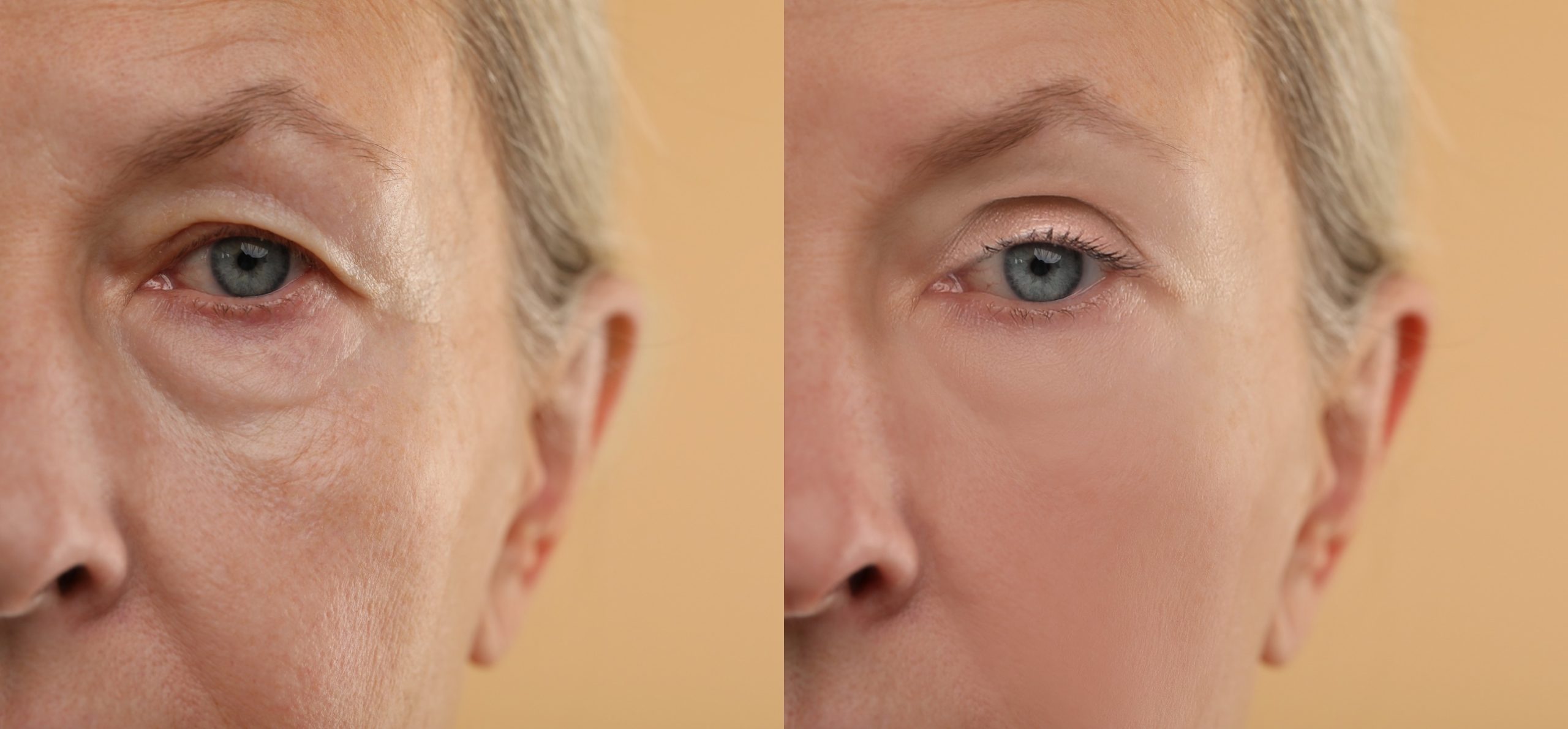 blepharoplasty Before and After Picture