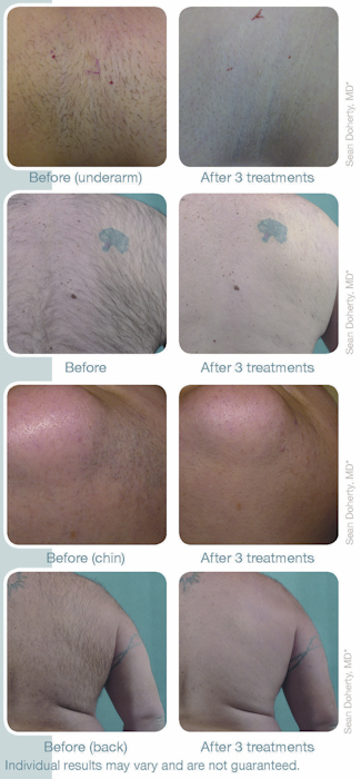 The advantages of laser hair removal with the Vectus™ Laser are clear: 