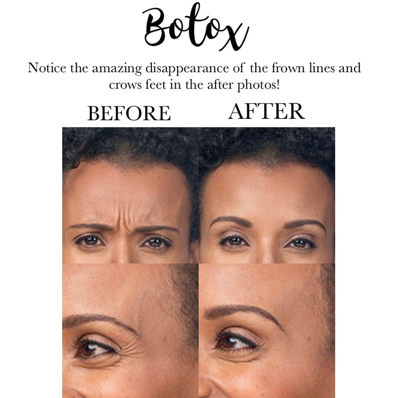 Botox Before and After Treatment