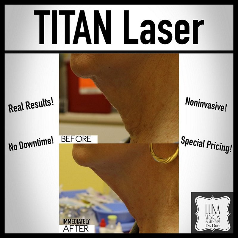 Pittsburgh Titan Laser Treatments
